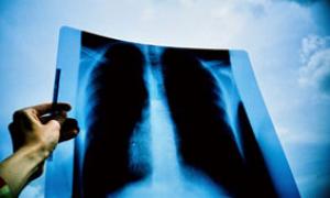 Lung Cancer: What’s a Biomarker?