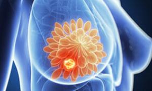 breast_cancer_original300x170.jpg